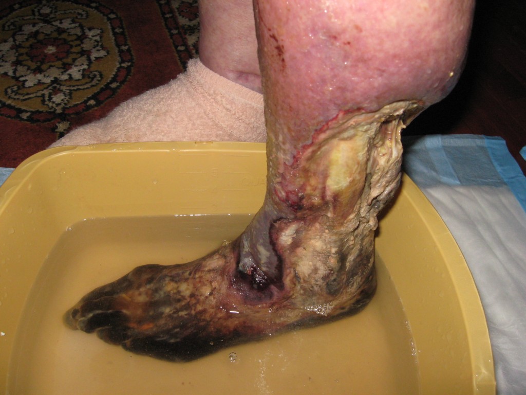 Krokodil: Flesh Eating Homemade Russian Heroin!