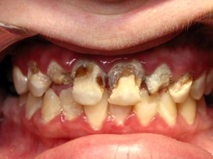 Meth Mouth